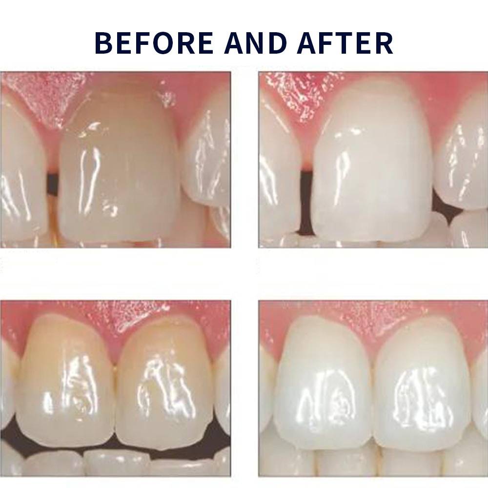 Opalescence beyazlatma 20% PF  - Teeth Whitening Opalescence incelemesi ve fiyatı