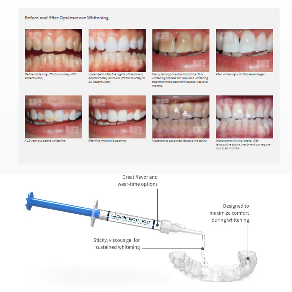 Opalescence beyazlatma 20% PF  - Teeth Whitening Opalescence incelemesi ve fiyatı